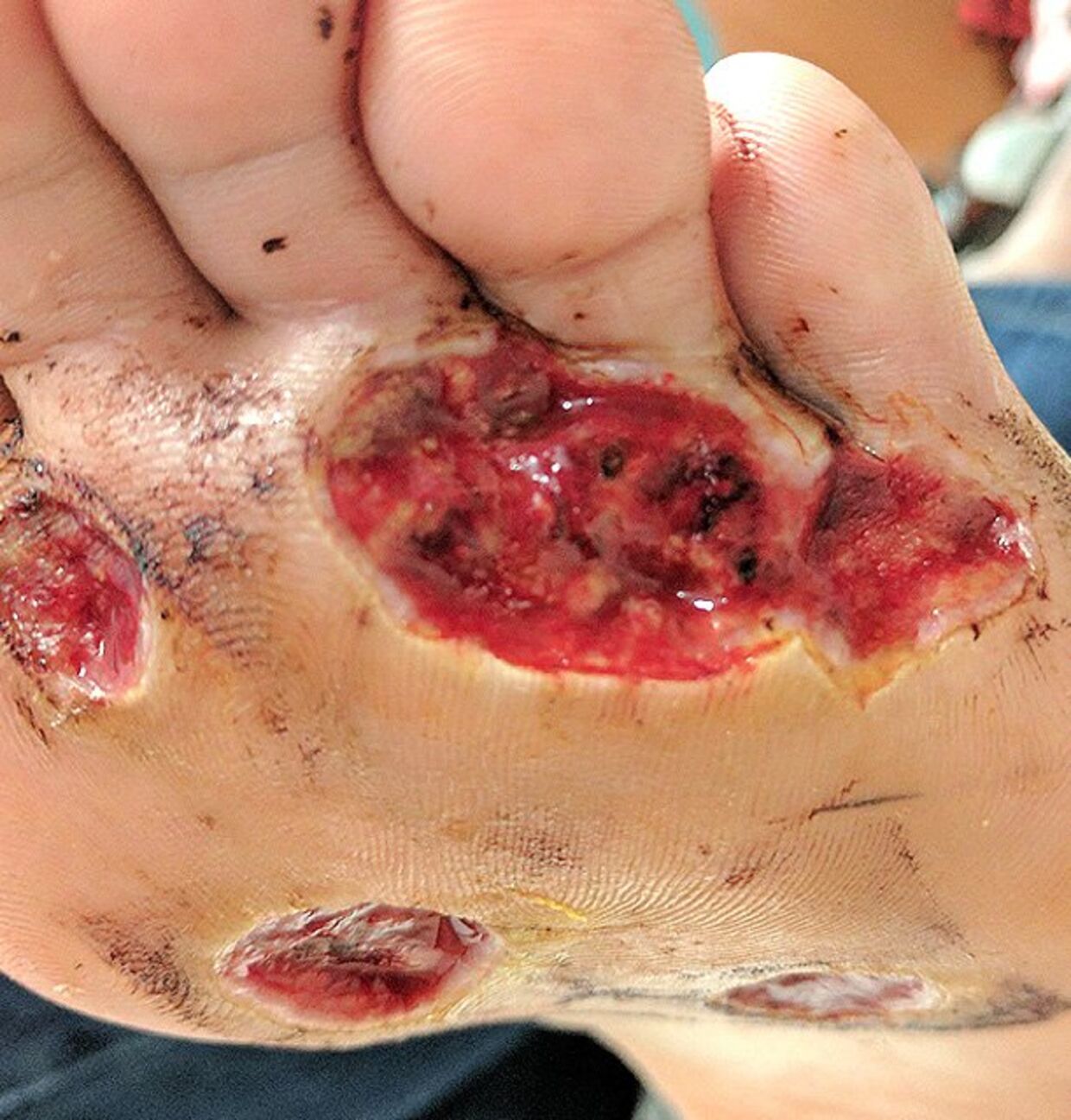 En amerikansk mands ene fod blev udsat for et udsædvanligt angreb fra en kødædende bakterie. Nu advarer han andre om ikke at gå barfodet. 