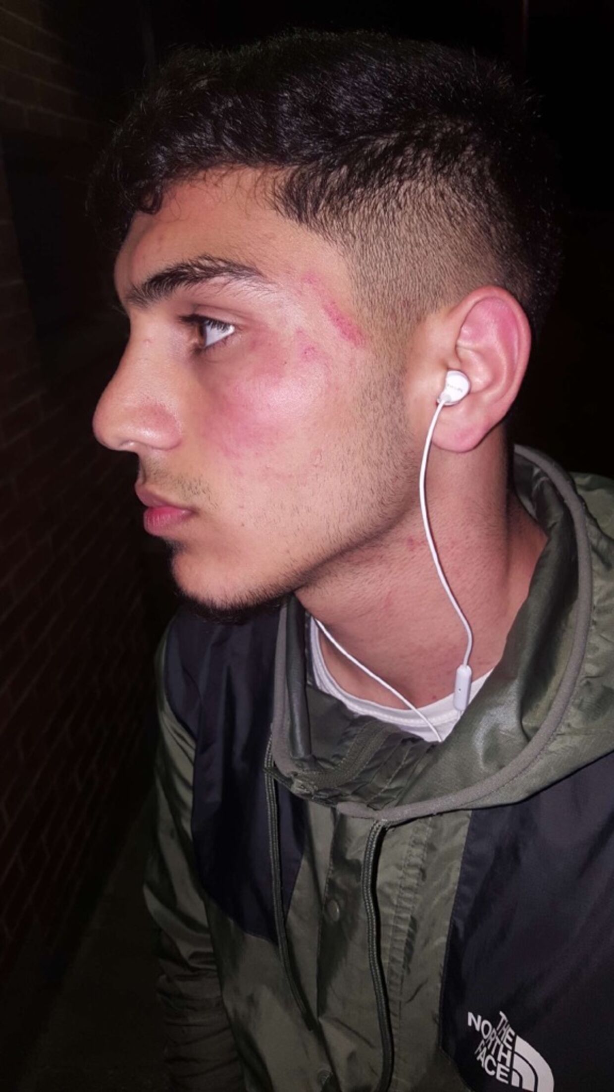 Af skaderapporten fremgår det, at Mohamad har fået en blodansamling under højre øje samt hudafskrabninger ved venstre øje.