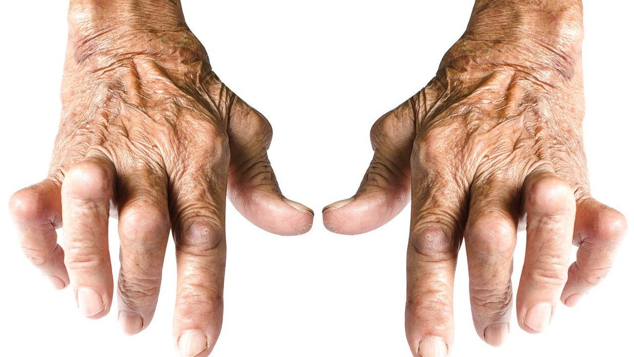 Før den biologiske medicin kom på markedet, var mange leddegigtpatienter stærkt plagede af deres smerter. Her ses et par 'krogede' hænder, som i dag er et sjældent syn blandt patientgruppen grundet de medicinske fremskridt. 
