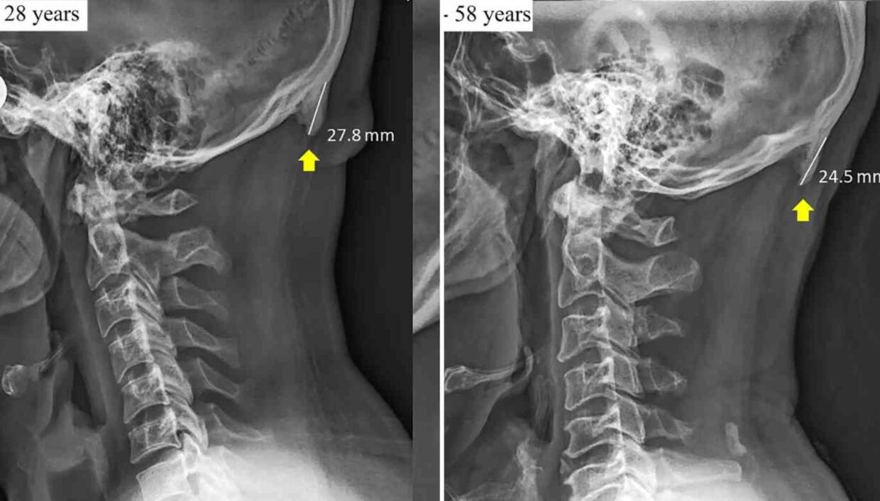 Røntgenbillederne her viser kraniet på to mænd. Billedet til højre viser knoglevæksten på en 58-årig mand, mens billedet til venstre viser knoglevæksten på en 28 år gammel mand.