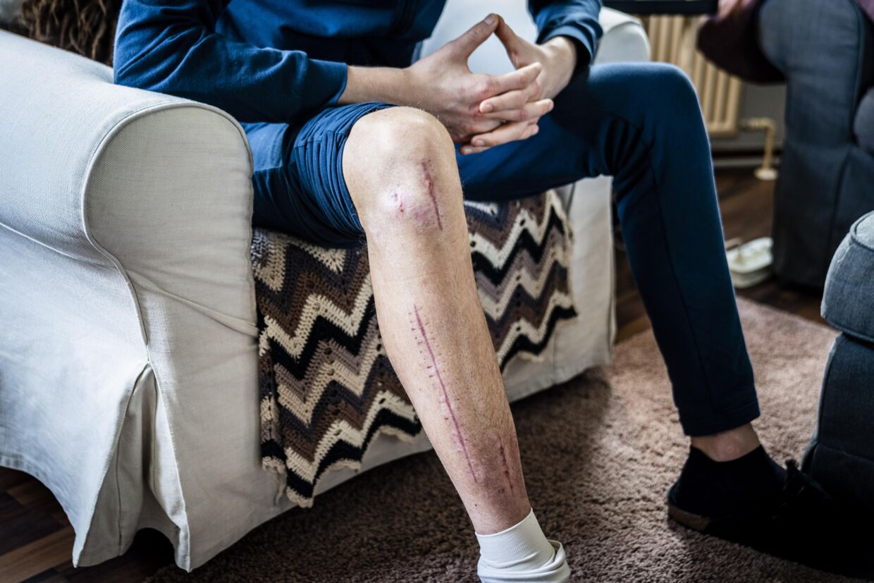 Mathias Norsgaard viser benet frem, som han fik smadret under sin træningsulykke.