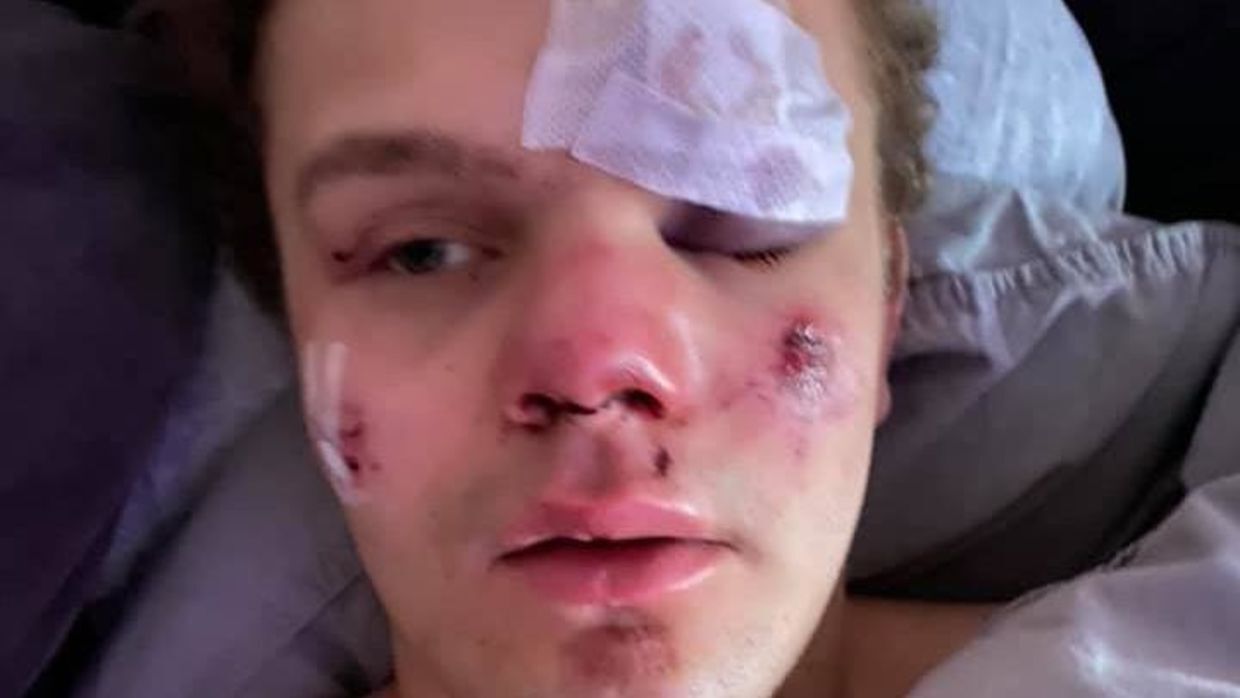 Lindboe Wind blev natten mellem fredag og lørdag den 22. februar overfaldet, slået bevidstløs og kastet ud foran en bil. Sådan så han ud i dagene efter overfaldet. Privatfoto