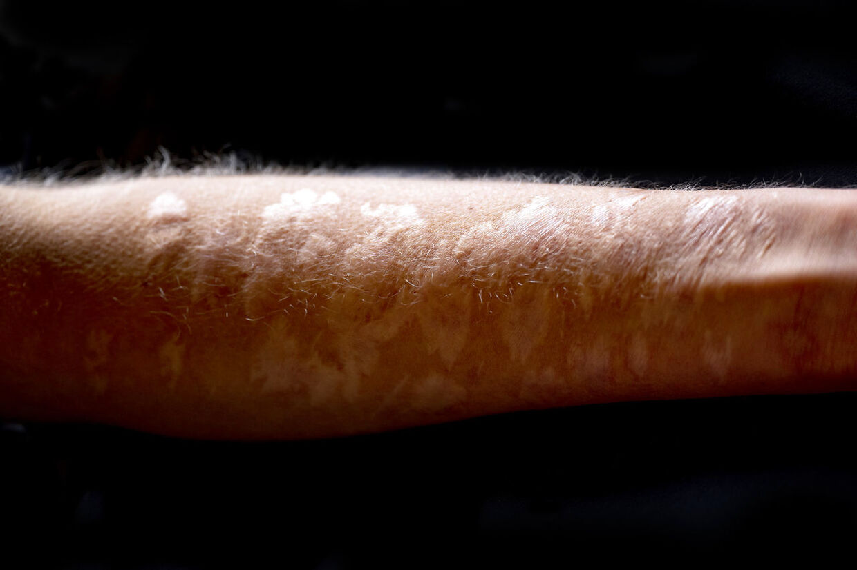 Majas arme bærer præg af mange år med selvskade på forskellige bosteder. Hun bed selv huller i sine arme. 