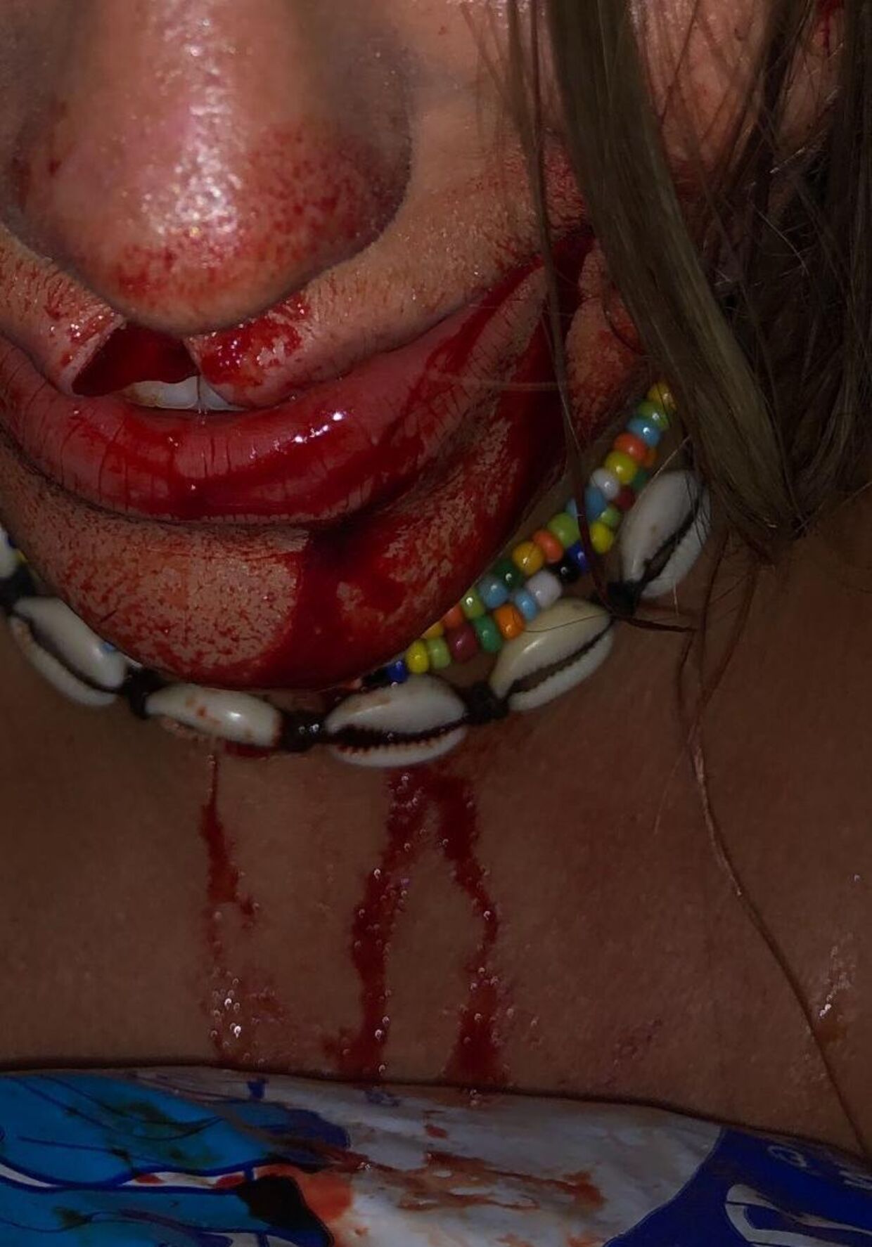Hendes læbe blev skåret over af glasset, som danskeren kastede i hovedet på hende.