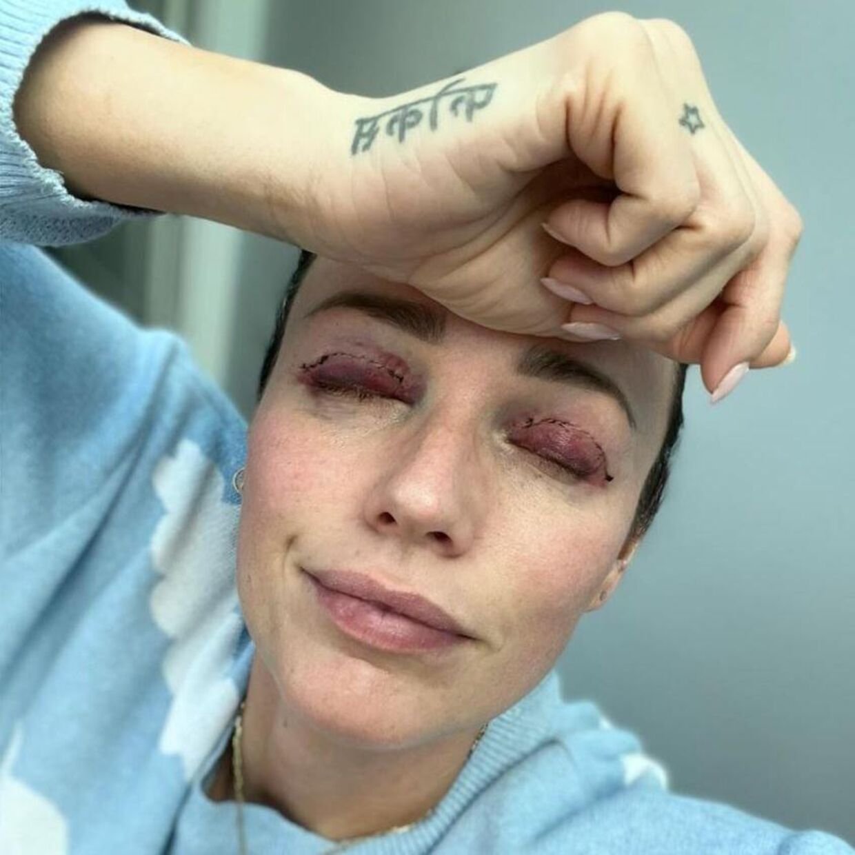 Lisbeth Østergaard har fået opereret begge sine øjenlåg, og det har efterladt hende med hævede blå øjne og sting.