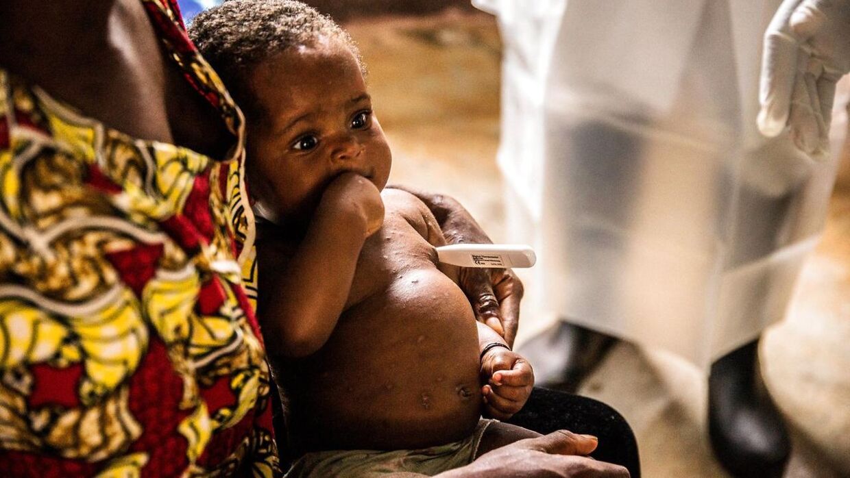 Et lille nigeriansk barn med abekopper.