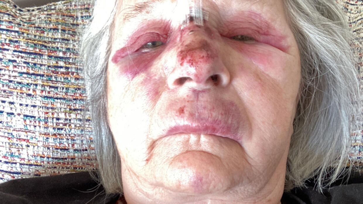 Yvonne Christiansen kom slemt til skade, da hun skulle handle i sit lokale apotek. Foto: Privatfoto