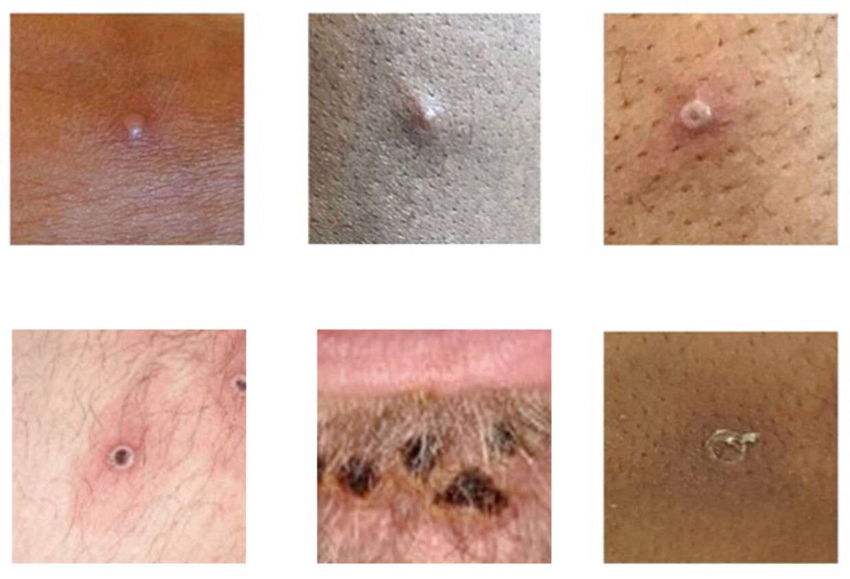 Blærer på huden er et af de meget tydelige symptomer på abekopper.