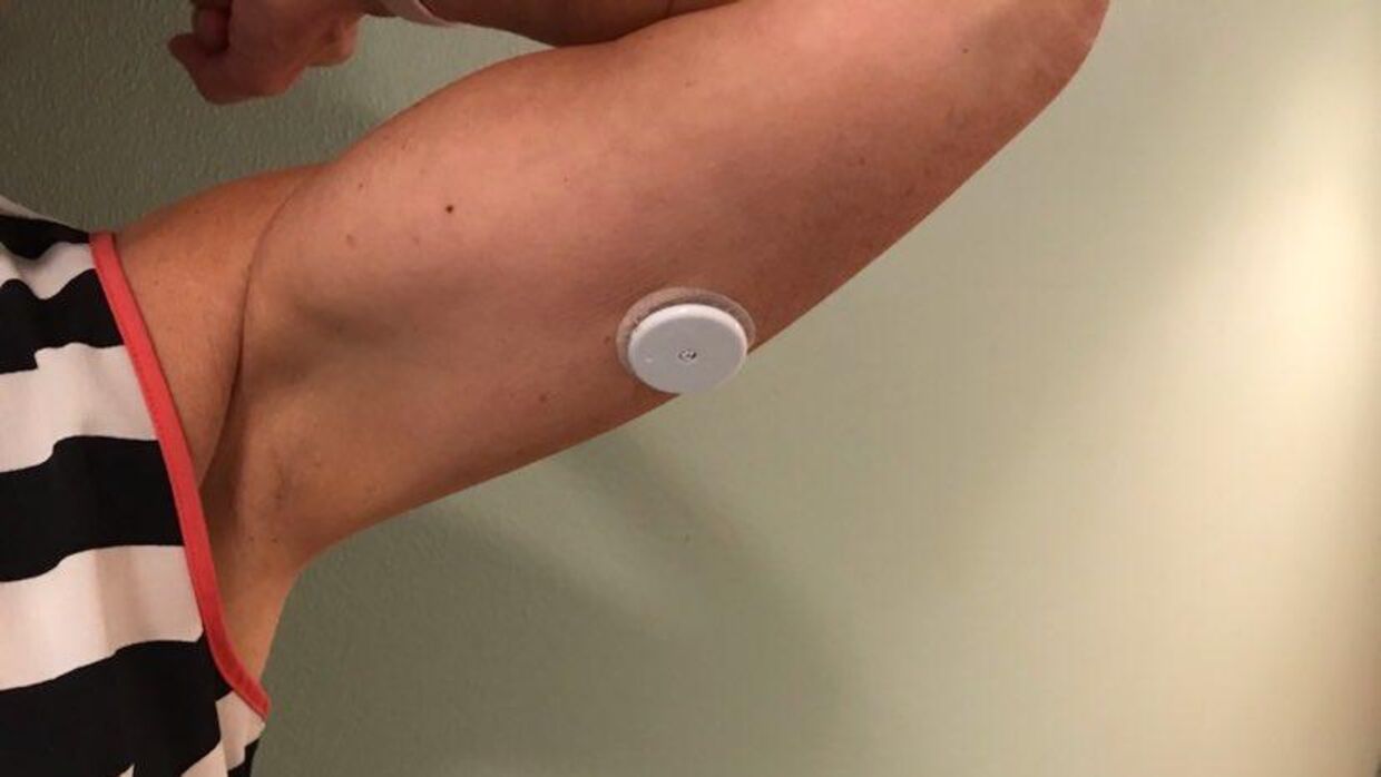 Her ses den sensorbaserede glukosemåler, der er koblet sammen med en app på mobiltelfonen, så Bodil Ravn hele tiden kan overvåge sit blodsukker. Sensoren aktiverer en alarm, hvis blodsukkeret er for lavt eller for højt. Foto: Privat.