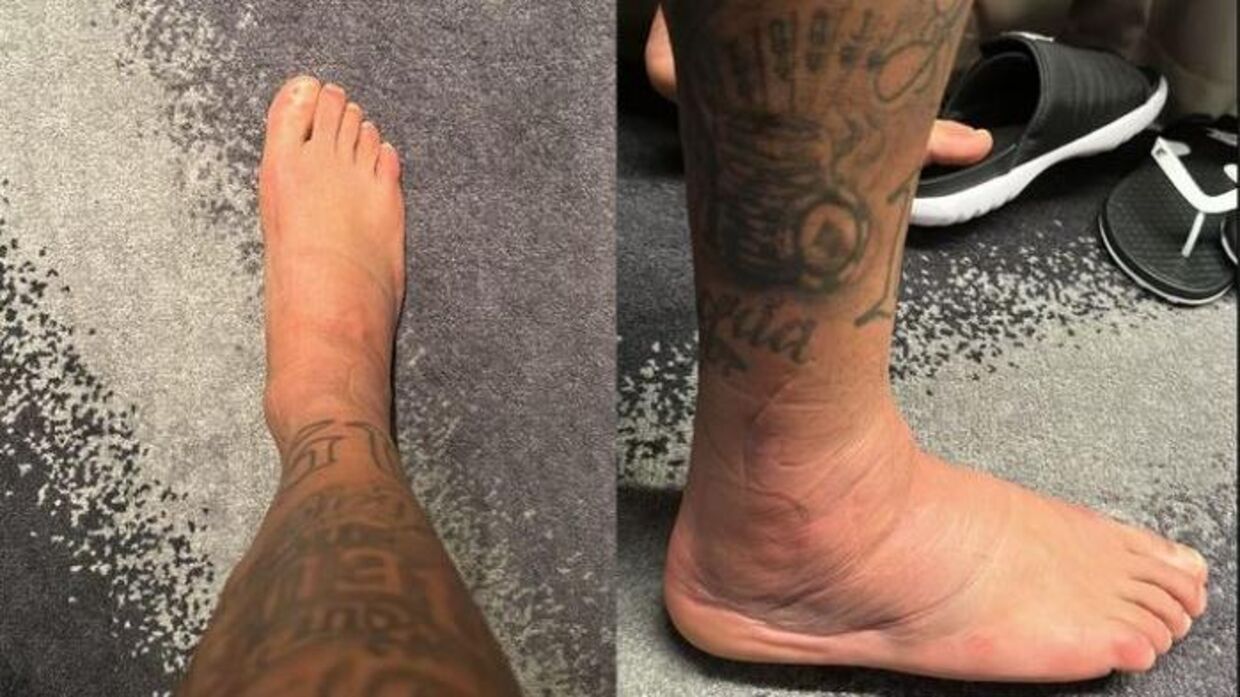 Sådan så Neymars ankel ud efter han blev skadet i brasilianernes åbningskamp mod Serbein Foto: Screendump/Instagram
