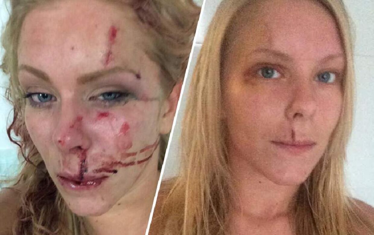 Nanna Skovmand ses her lige efter overfaldet og en uge senere. Hun og hendes kæreste blev overfaldet uden for deres hjem på Vesterbro i København julenat 2014.