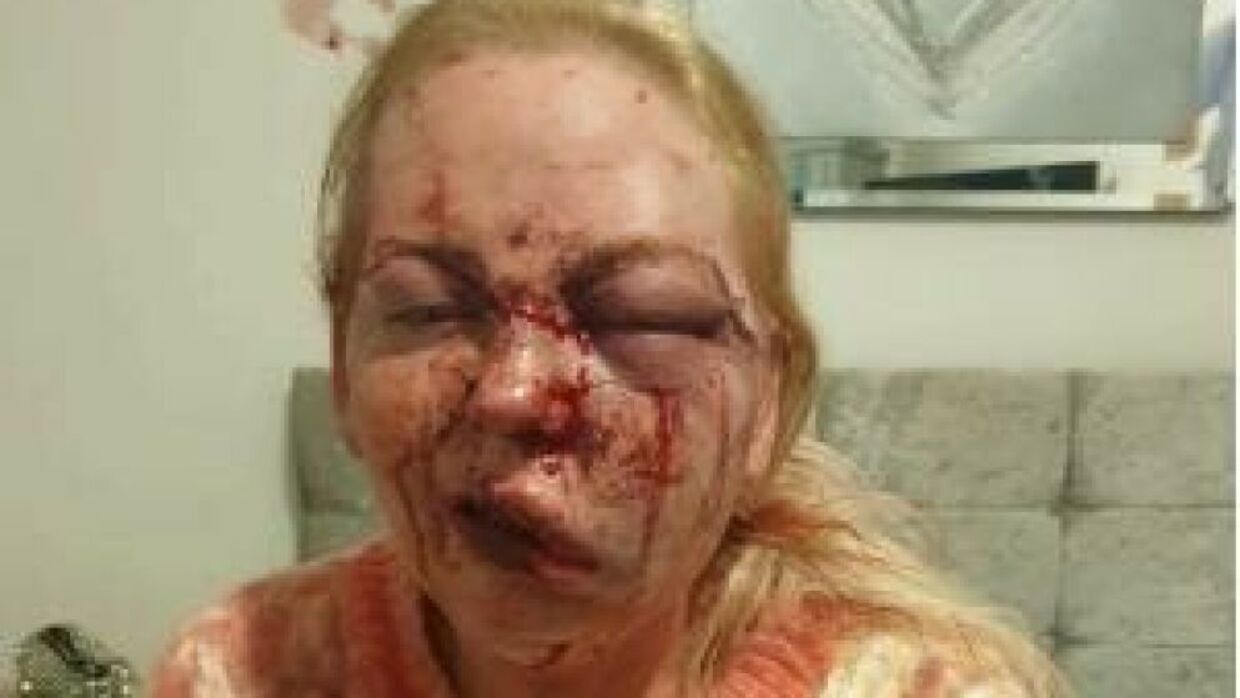 Kvindens ansigt havde omfattende skader efter et voldeligt overfald.
