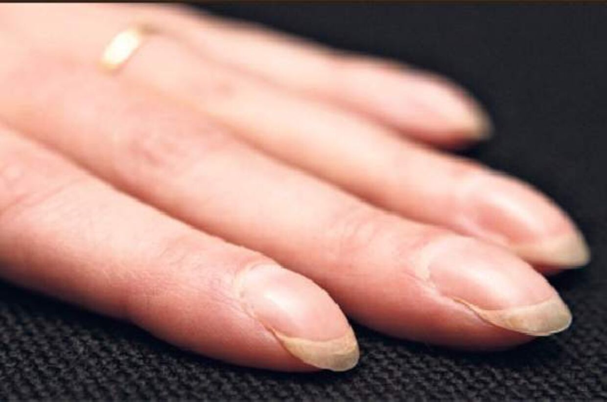 Stige protestantiske web Dine negle afslører din sygdom | BT Sygdomme - www.bt.dk