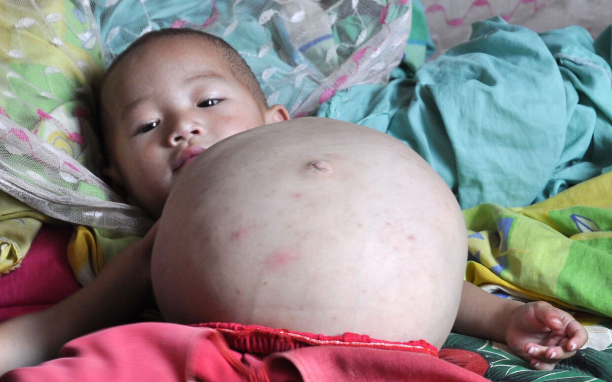 Et-årige Kang Mengru vil dø, hvis hun ikke snart får bortopereret det tvillingefoster, der gror i hendes mave.