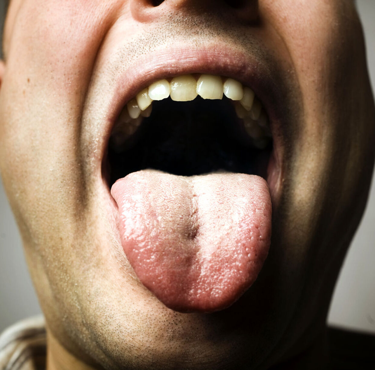 Kræft i tungen