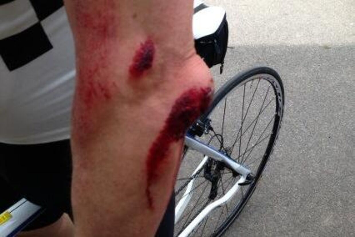 Sådan så Claus Elmings arm ud, efter at han i dag tog et vildt styrt på cyklen, hvor han knaldede hovedet ned i asfalten. Han måtte efter styrtet en tur forbi Gentofte Sygehus. 