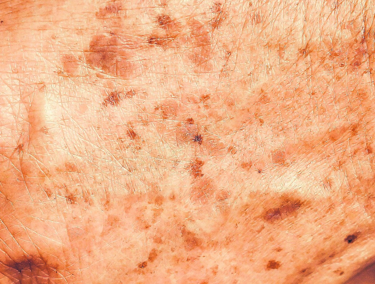 Runde røde pletter på huden