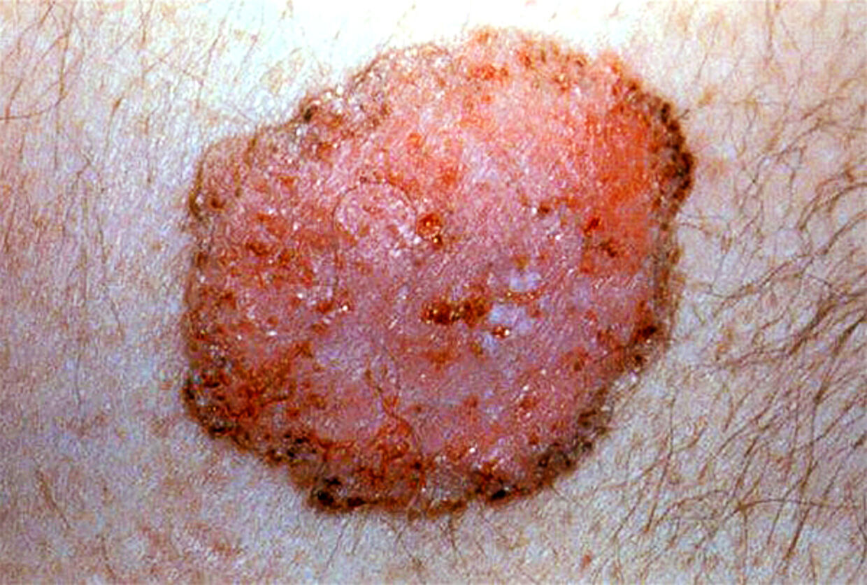 Huden på røde runde pletter Allergi