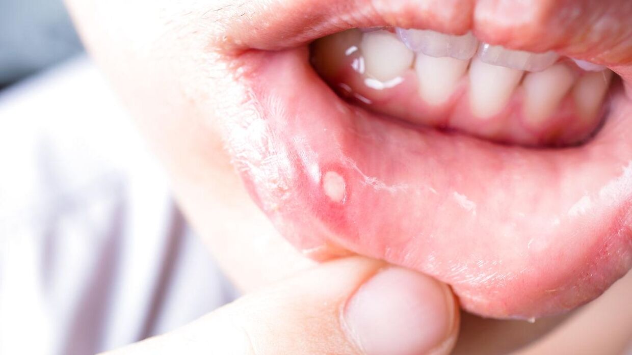 Tungen kræft i tungen cancer